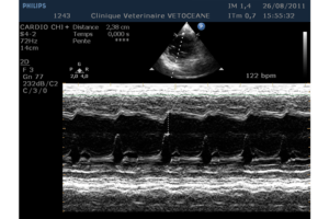 Cardiomyopathie dilatée mode TM