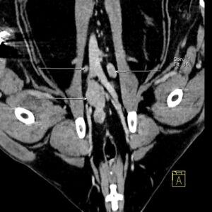 Métastases dans les noeuds lymphatiques hypogastriques et iliaques