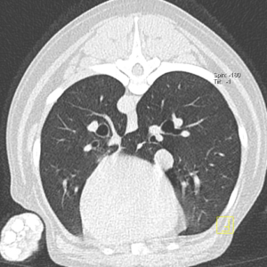 Scanner pulmonaire