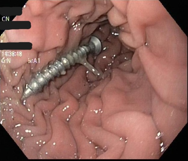 Visualisation d'un corps étranger digestif par endoscopie
