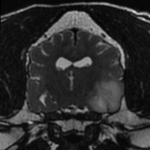 IRM encéphale transverse gliome