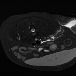 IRM fistule