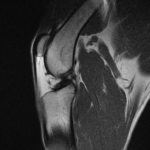 IRM grasset ligaments croisés