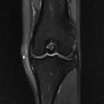 IRM grasset ligaments croisés ménisques