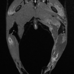 IRM muscles musculaire