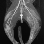 IRM muscles musculaire vasculaire
