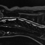 IRM rachis cervical moelle épinière hernie discale