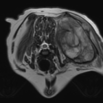 IRM tumeur nerfs transverse
